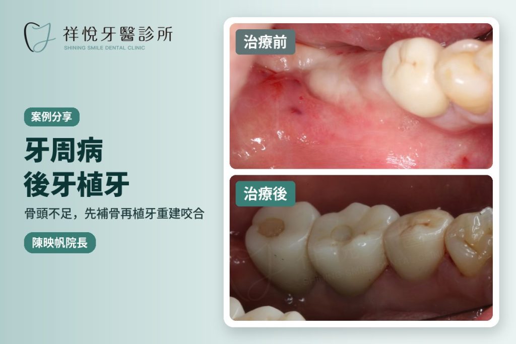 牙周病後牙植牙案例 先補骨再植牙 治療前後對比 陳映帆院長|湖口祥悅牙醫
